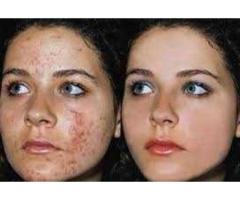 Heal and smooth your skin with Rollyhampy skin care products