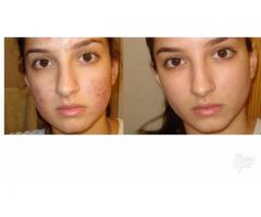 Ivory Caps Skin Whitening Pills +27760829927