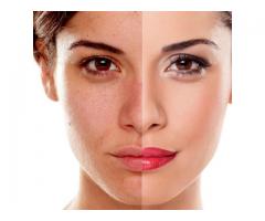 Acne Laser Treatment In South Africa