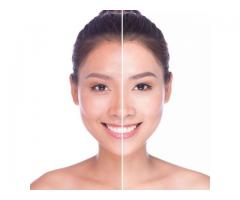 Acne Laser Treatment In South Africa