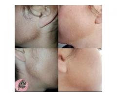 Remove Unwanted Facial Hair