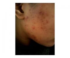Rollyhampy skin lightening products consist of unique safe ingredients